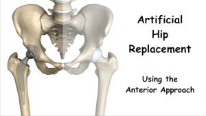 Hip Replacement