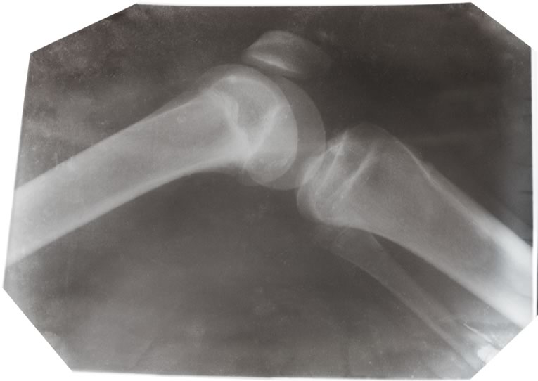 knee-bone-xray