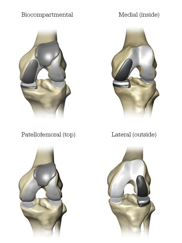 Knee CT Scan