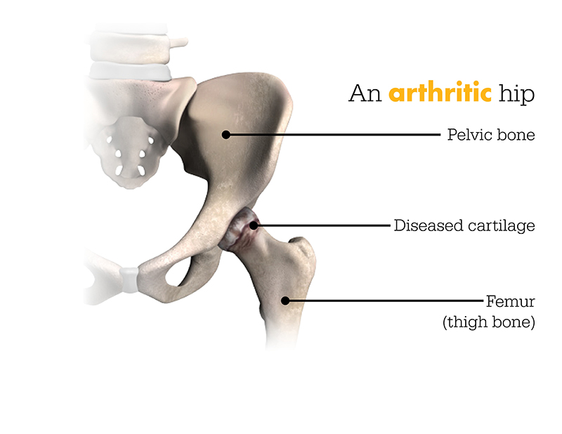 A Arthritic Hip