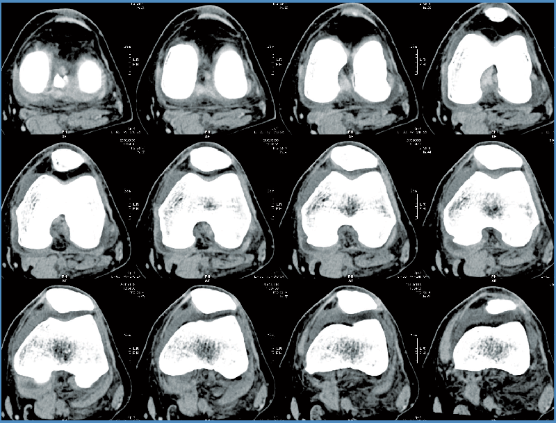 Mako Robotic-Arm Knee CT Scan