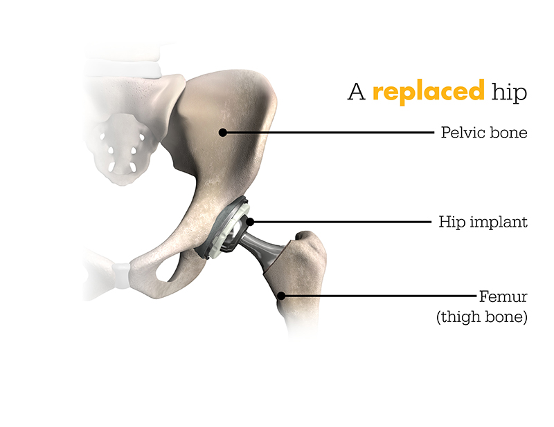 A Replaced Hip
