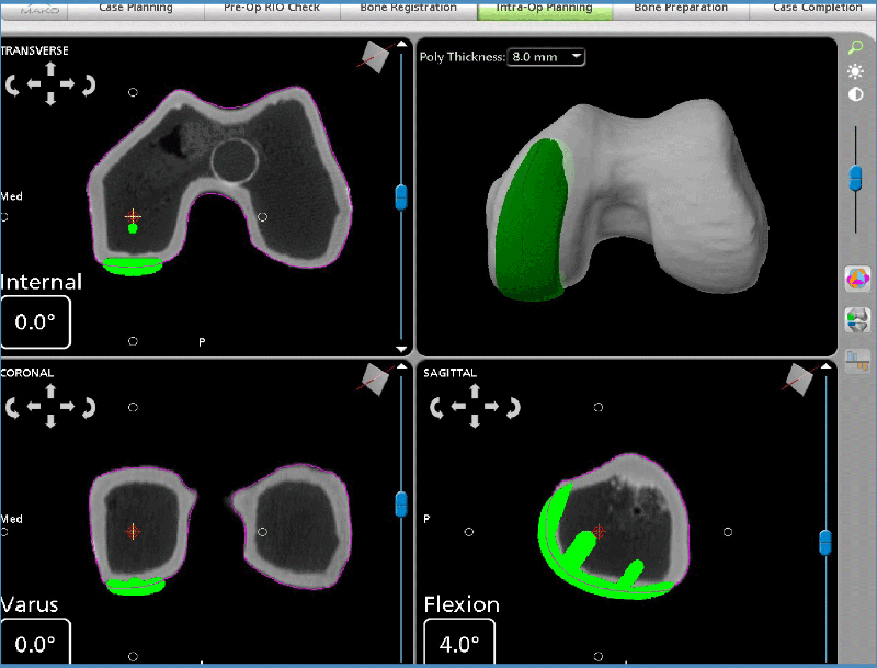 Knee CT Scan