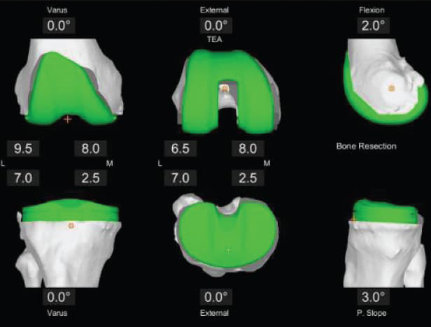  Personalized Pre-Operative Plan